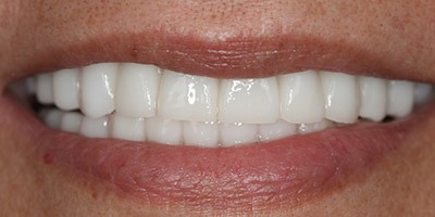 priestriverdental.com | Dental Implants