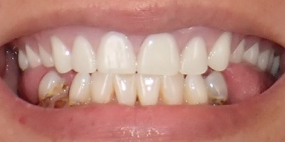 priestriverdental.com | Dental Implants