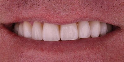 priestriverdental.com | Dental Implants