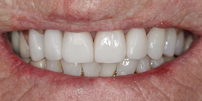 priestriverdental.com | Dental Implants