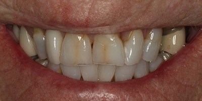 priestriverdental.com | Dental Implants