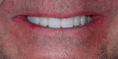 Priest River Dental before and after result