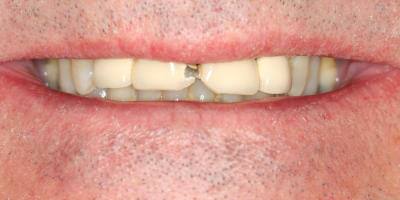 Priest River Dental before and after result