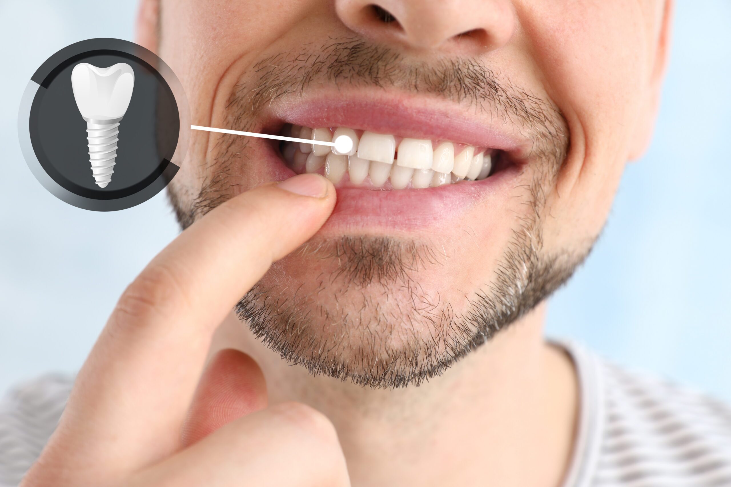 Restore Your Smile with Dental Implants at Priest River Dental